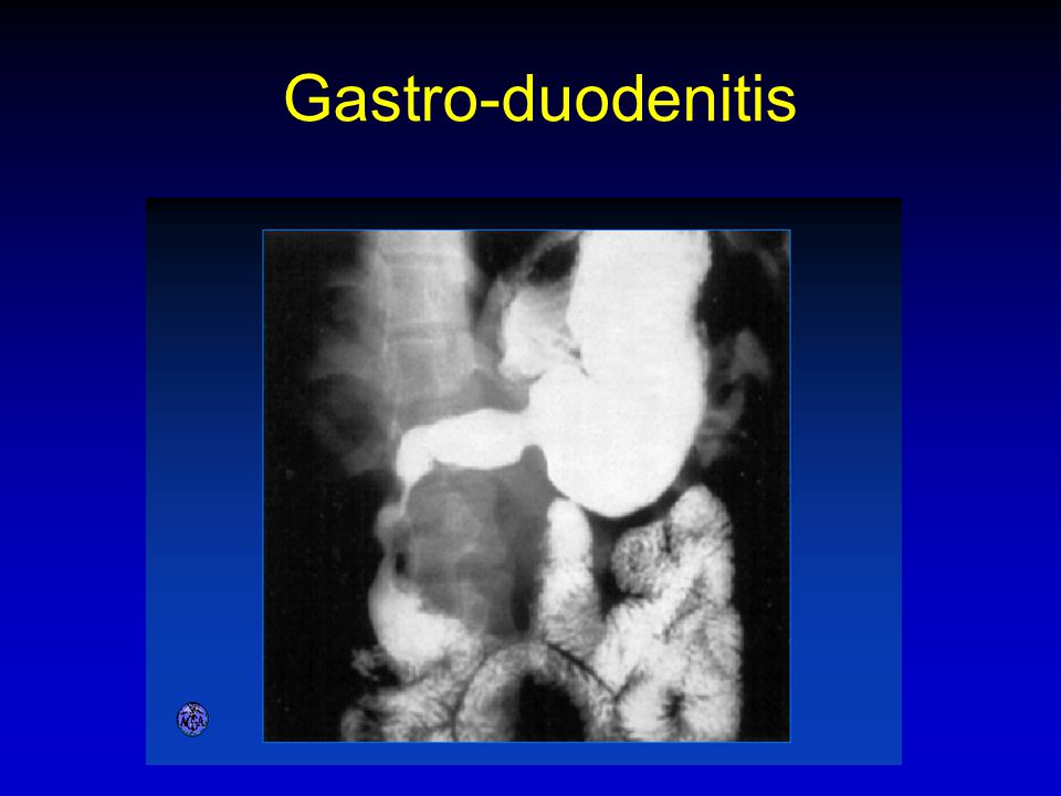 Gastro-duodenitis 77. GASTRO-DUODENITIS