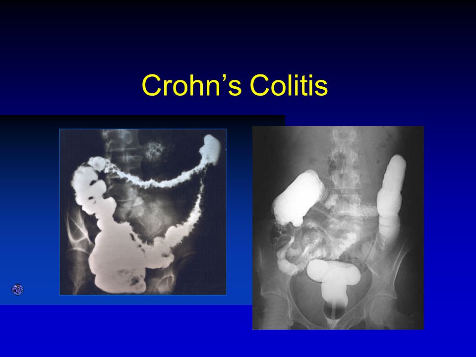 Crohn’s Colitis באריום של מעי גס – החלל מוצר.