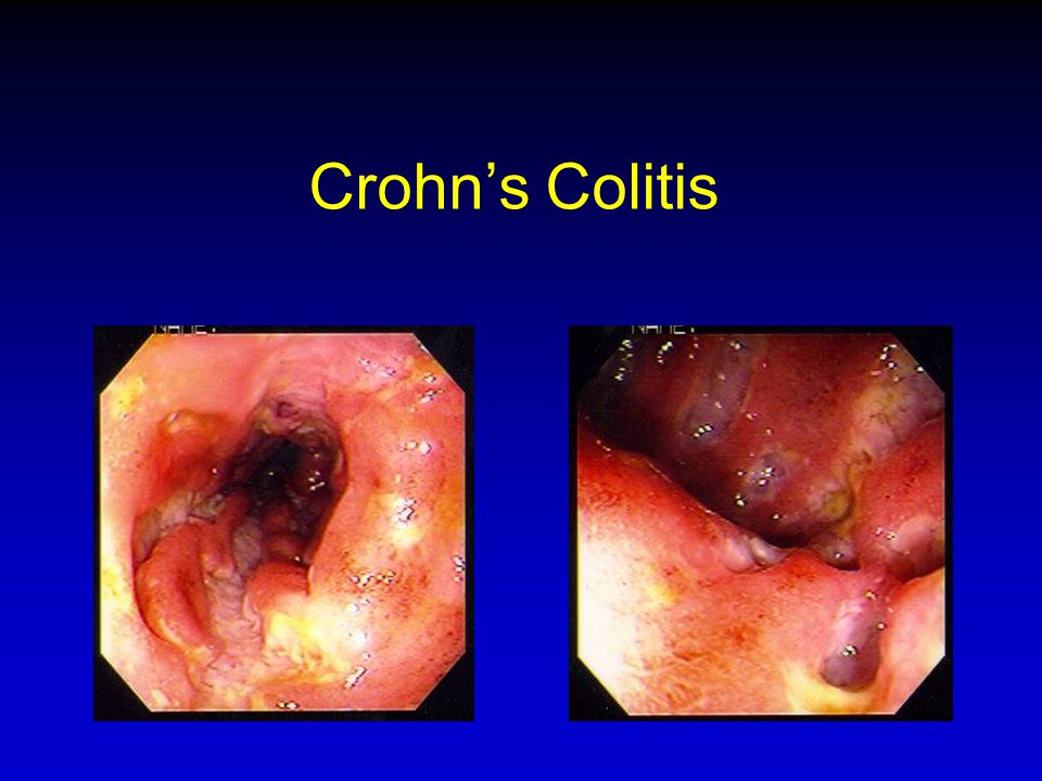 Crohn’s Colitis מחלה יותר מפותחת, כיב עמוק, שהופך לעוד כיבים, בצקת של הרירית ותהליך דלקתי.