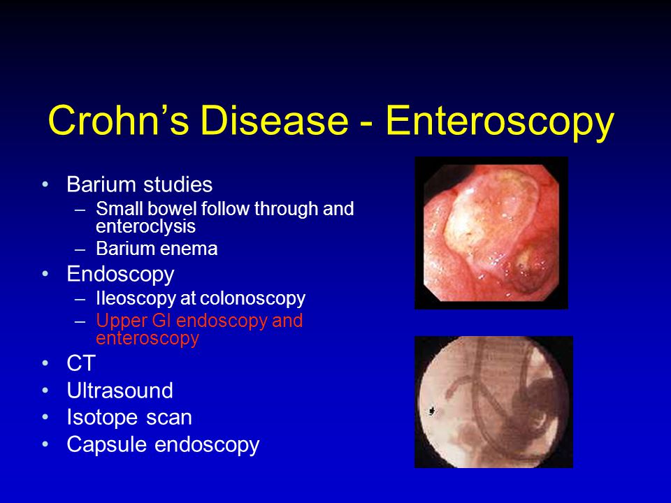 Crohn’s Disease - Enteroscopy