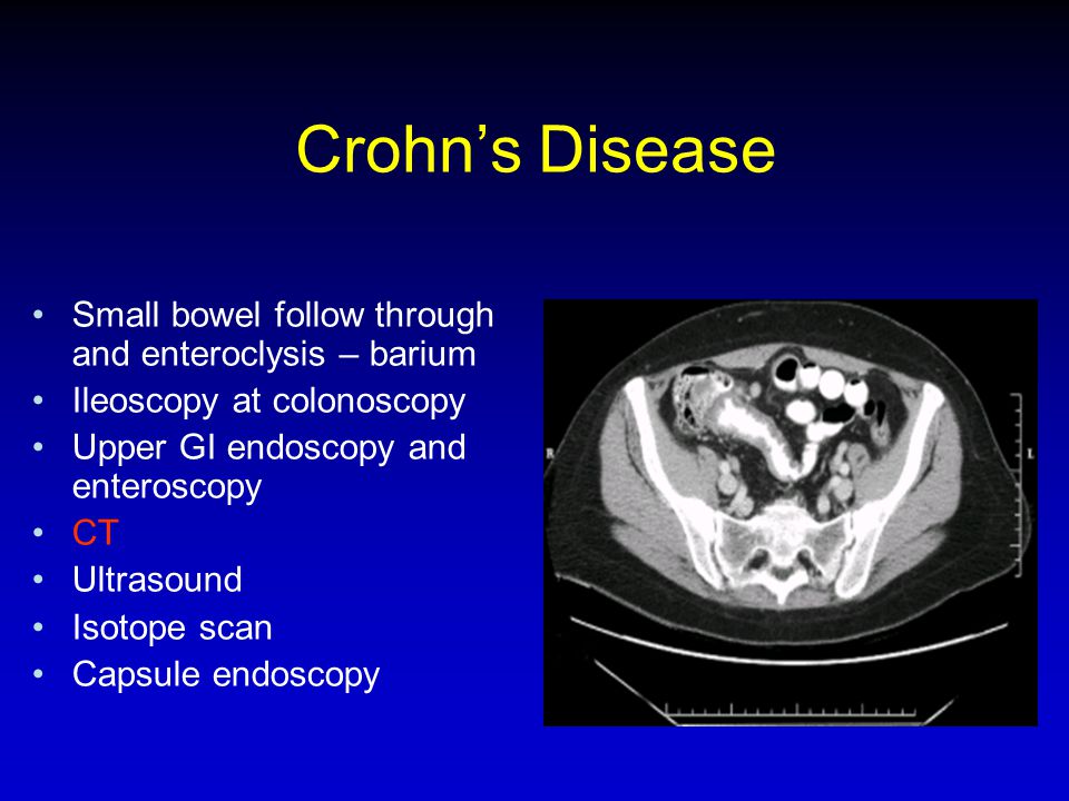 Crohn’s Disease Small bowel follow through and enteroclysis – barium