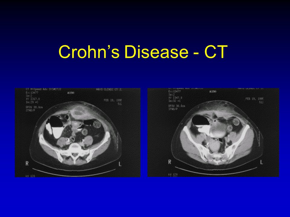 Crohn’s Disease - CT CT יכול לעזור – אדם עם אבצס בבטן כתוצאה מנזילה, דליפה של תוכן והדבקה של המעי הדק (מחלה טרנס-מוראלית) ויש אבצס בחלל הבטן.