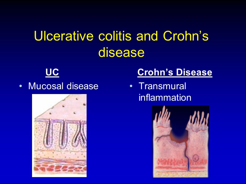 Ulcerative colitis and Crohn’s disease