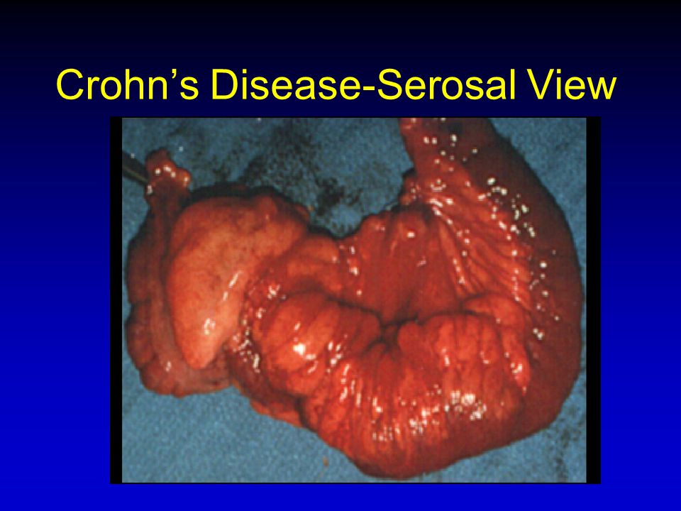 Crohn’s Disease-Serosal View