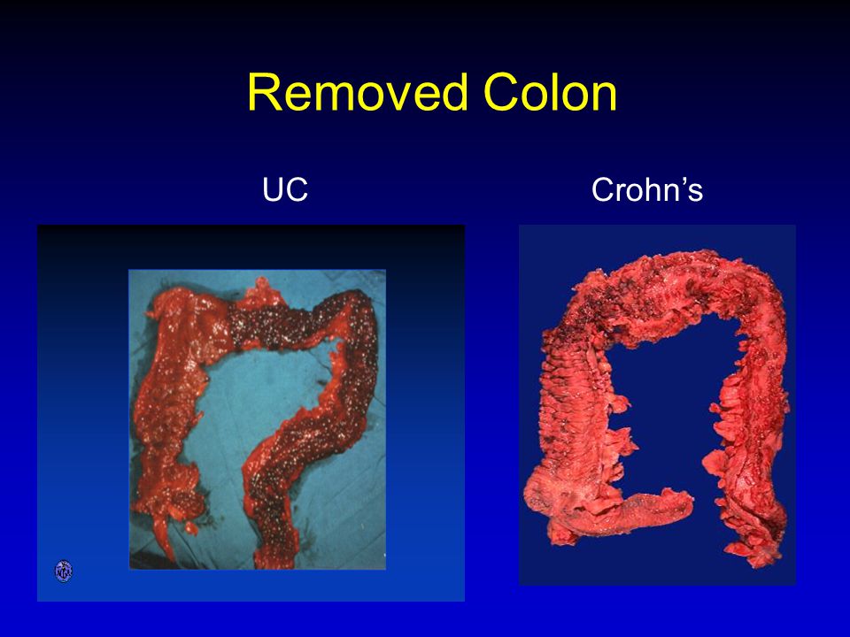 Removed Colon UC Crohn’s 6. GROSS PATHOLOGY OF ULCERATIVE COLITIS