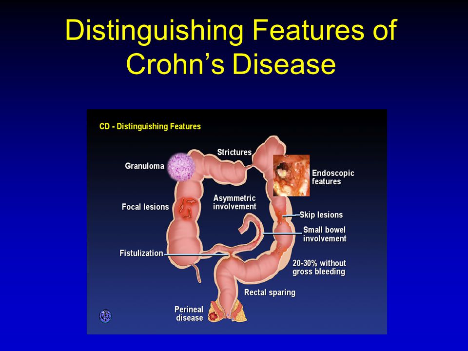 Distinguishing Features of Crohn’s Disease