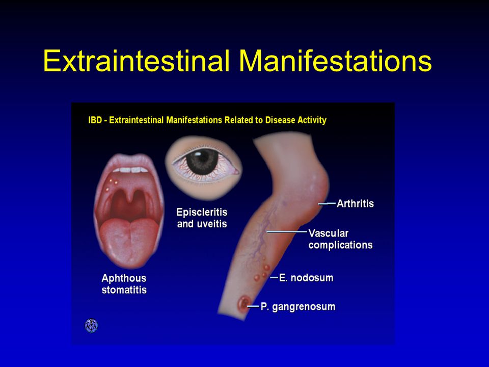 Extraintestinal Manifestations