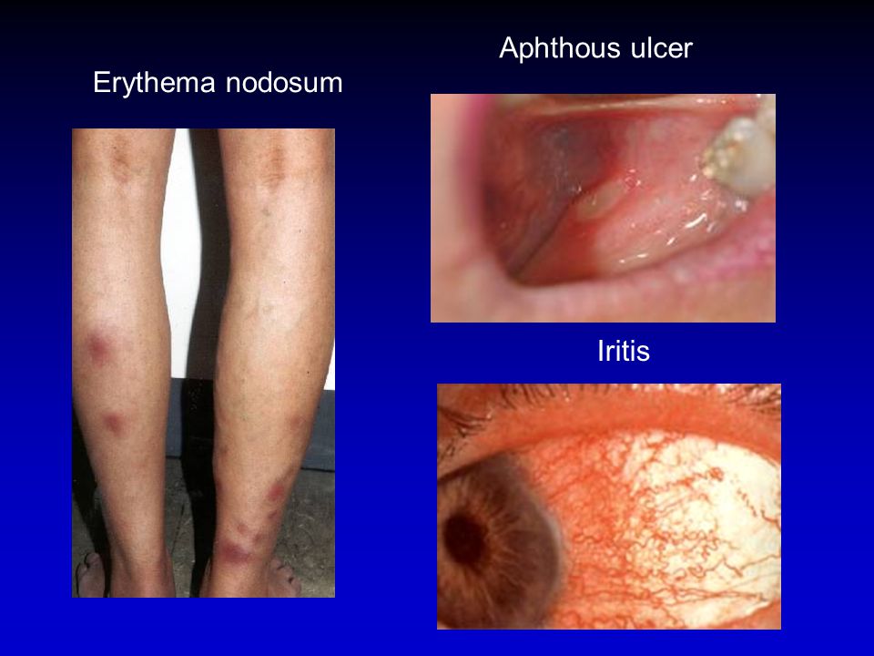 Aphthous ulcer Erythema nodosum Iritis דלקת עיניים, כיבים בפה, אריתמה.