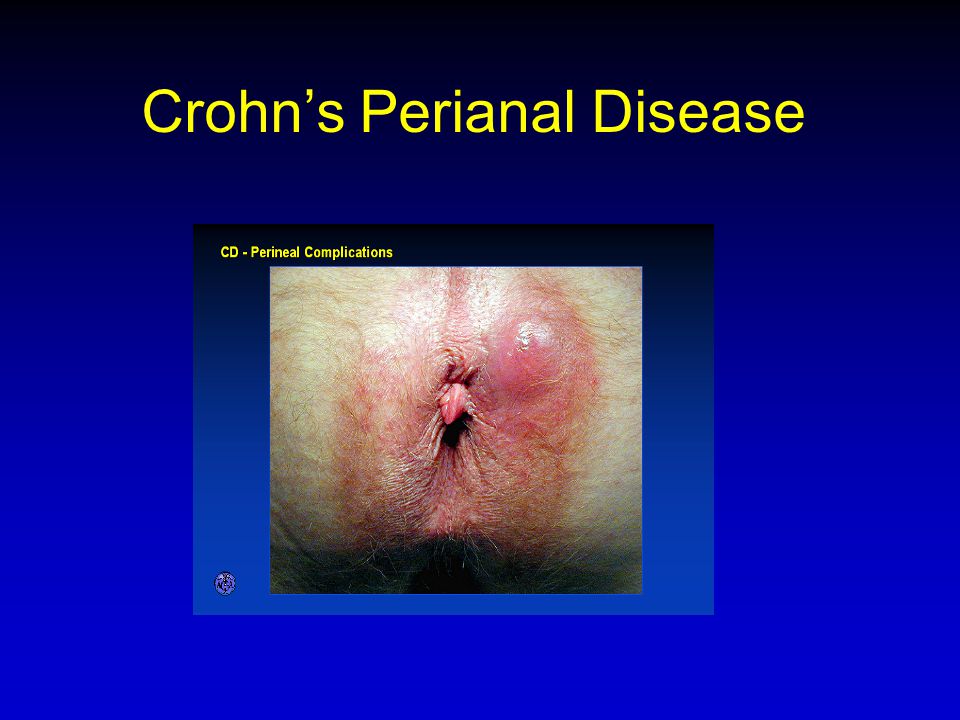 Crohn’s Perianal Disease