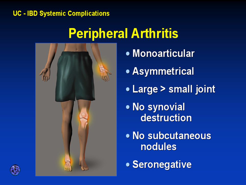 PERIPHERAL ARTHRITIS 54. PERIPHERAL ARTHRITIS
