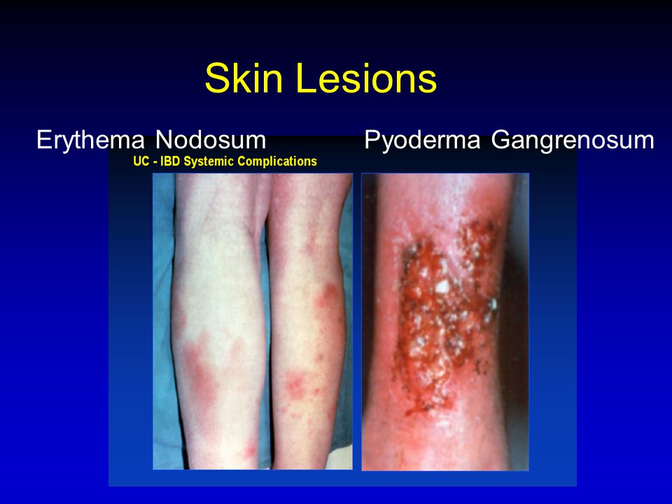 Skin Lesions Erythema Nodosum Pyoderma Gangrenosum