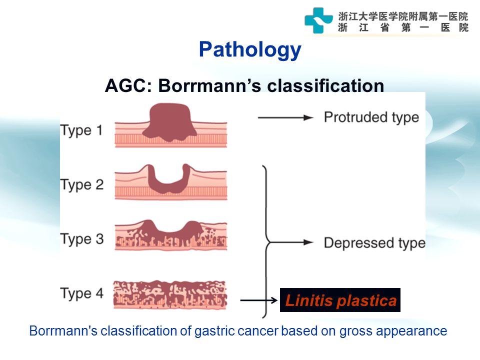 gastric cancer borrmann