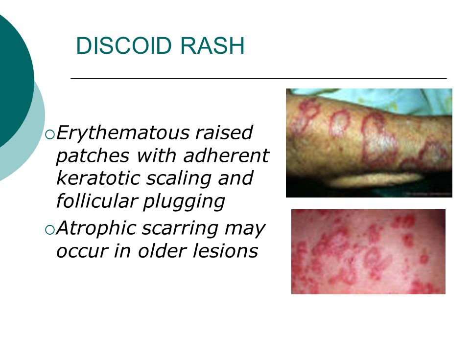 DISCOID RASH Erythematous raised patches with adherent keratotic scaling and follicular plugging.