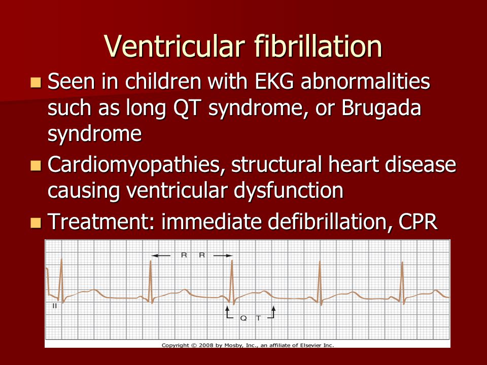 Ventricular fibrillation.