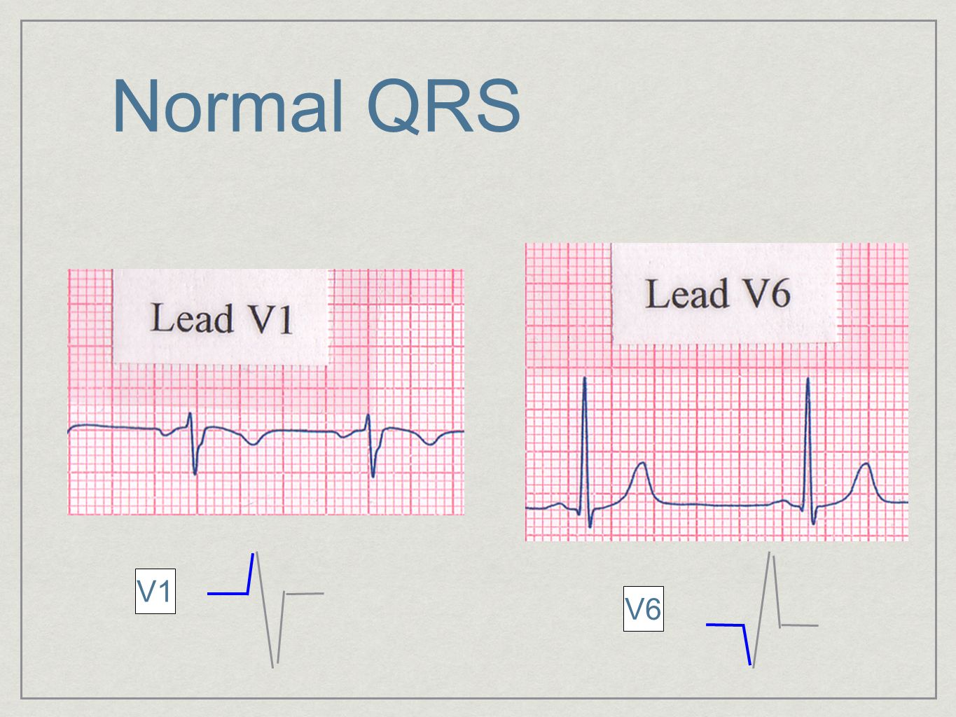 Qrs на экг что это. QRS В v1. Положительный QRS В v1. Измененный сегмент QRS В v1. Детектор QRS комплексов схема.