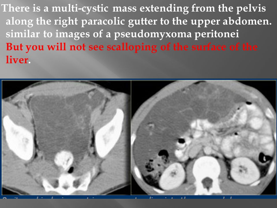 Peritoneum And Mesentery Ppt Video Online Download