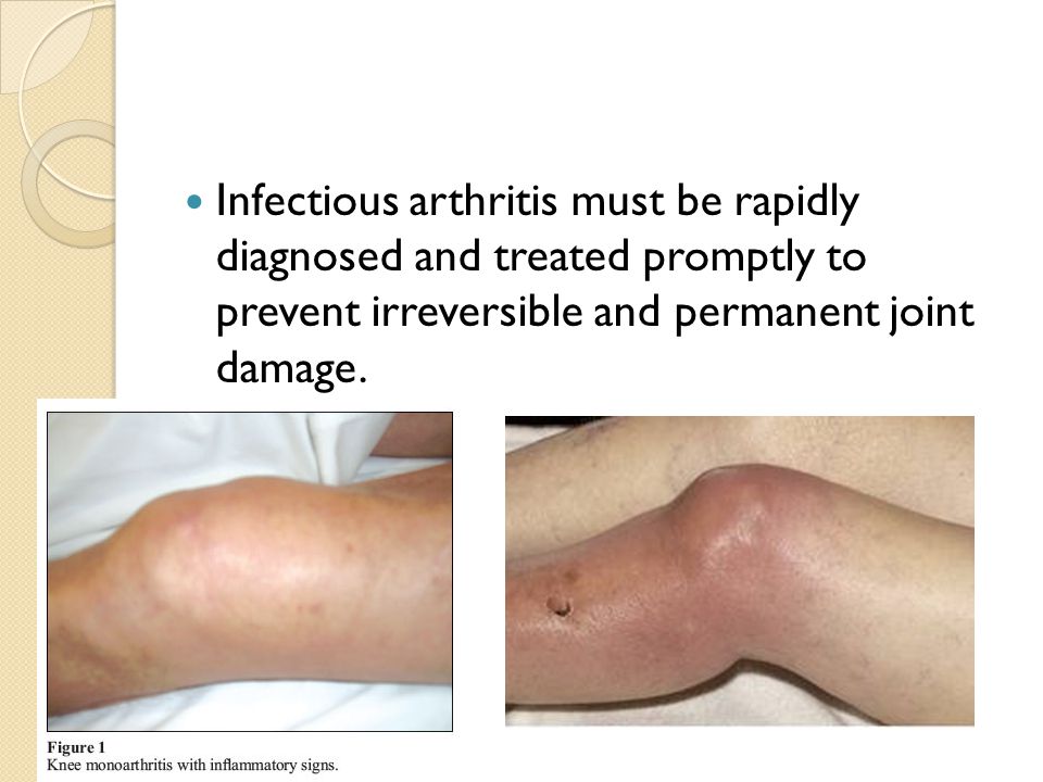 Infectious arthritis must be rapidly diagnosed and treated promptly to prevent irreversible and permanent joint damage.