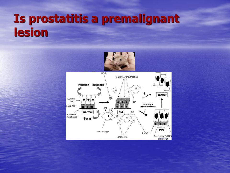 A prostatitis fűtés kezelése Krónikus prosztatitis az ICD- n