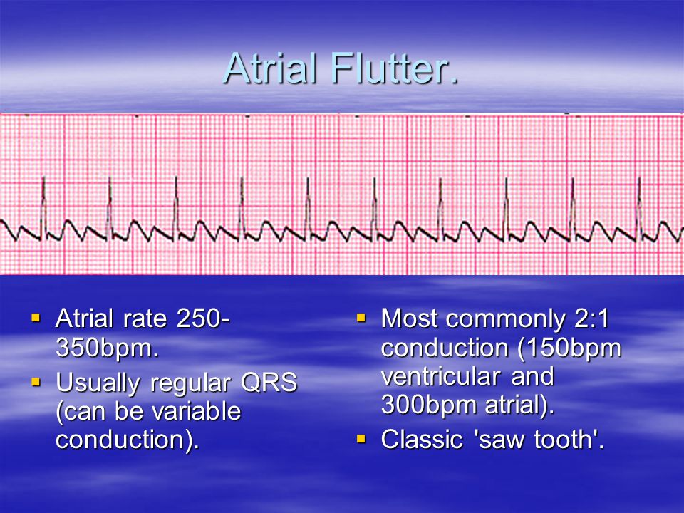 What Is The Difference Between Atrial Fibrillation (A-fib), 57% OFF