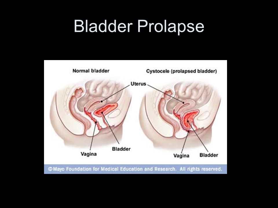 Prolapse Anime