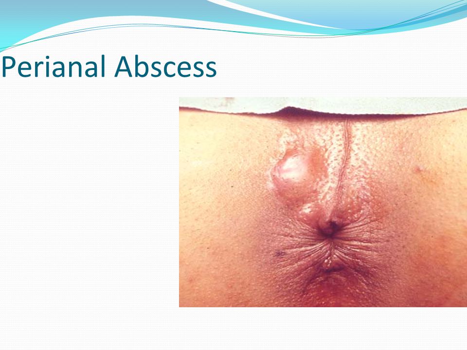 Anal fissure surgery johannesburg