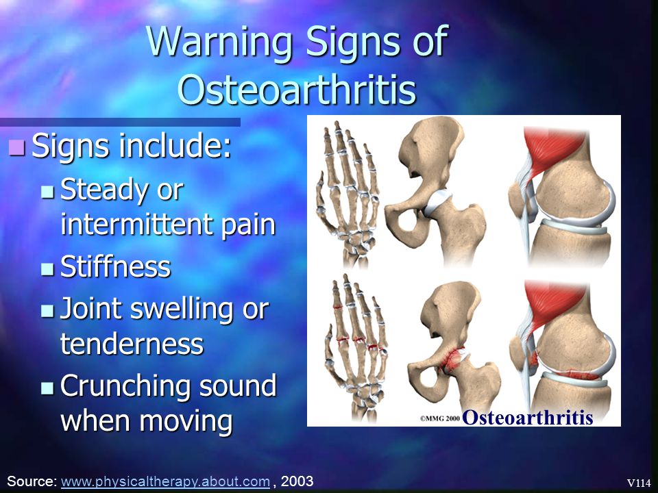 Warning Signs of Osteoarthritis