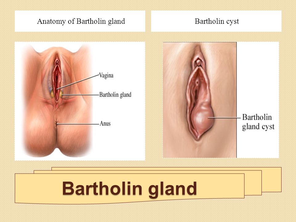 Benign vaginal cysts and lesions