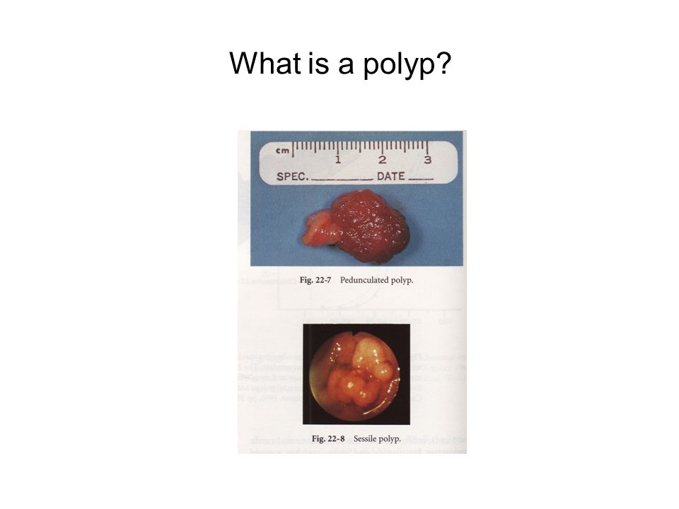What is a polyp