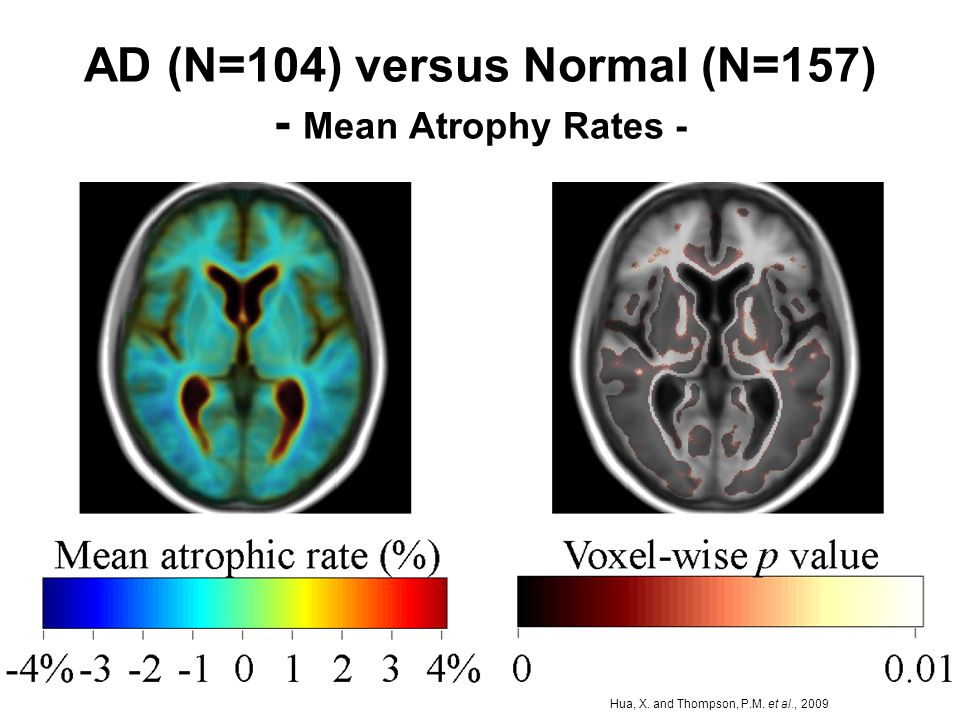 AD (N=104) versus Normal (N=157) - Mean Atrophy Rates -