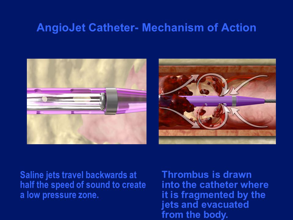 AngioJet Catheter- Mechanism of Action