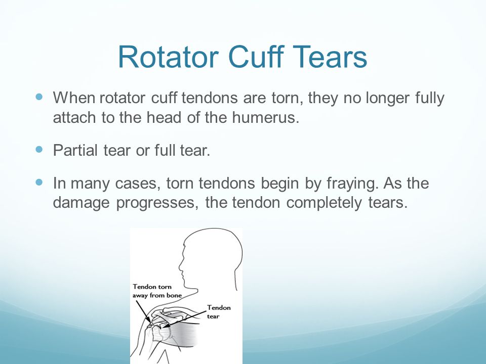 Rotator Cuff Tears When rotator cuff tendons are torn, they no longer fully attach to the head of the humerus.