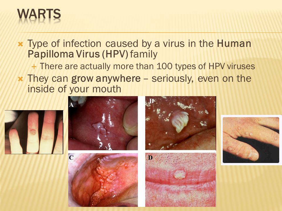 Warts Type of infection caused by a virus in the Human Papilloma Virus (HPV...
