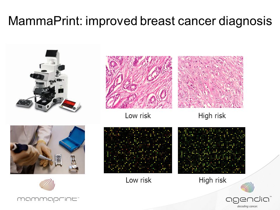 MammaPrint: improved breast cancer diagnosis