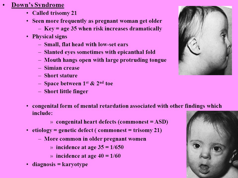 Down’s Syndrome Called trisomy 21.