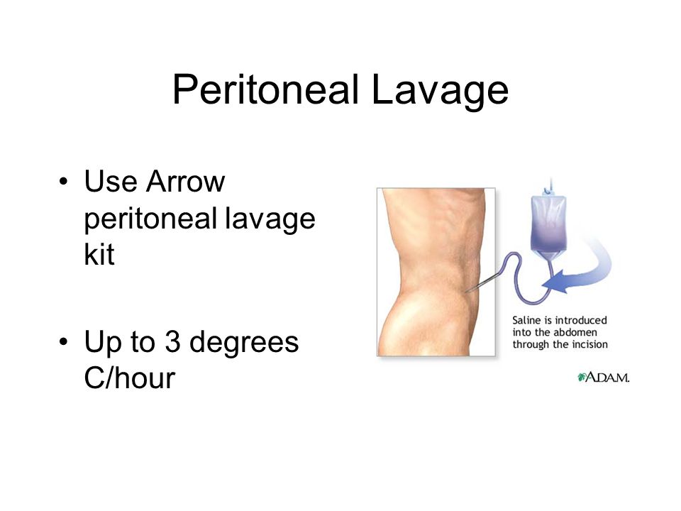Peritoneal Lavage Use Arrow peritoneal lavage kit.