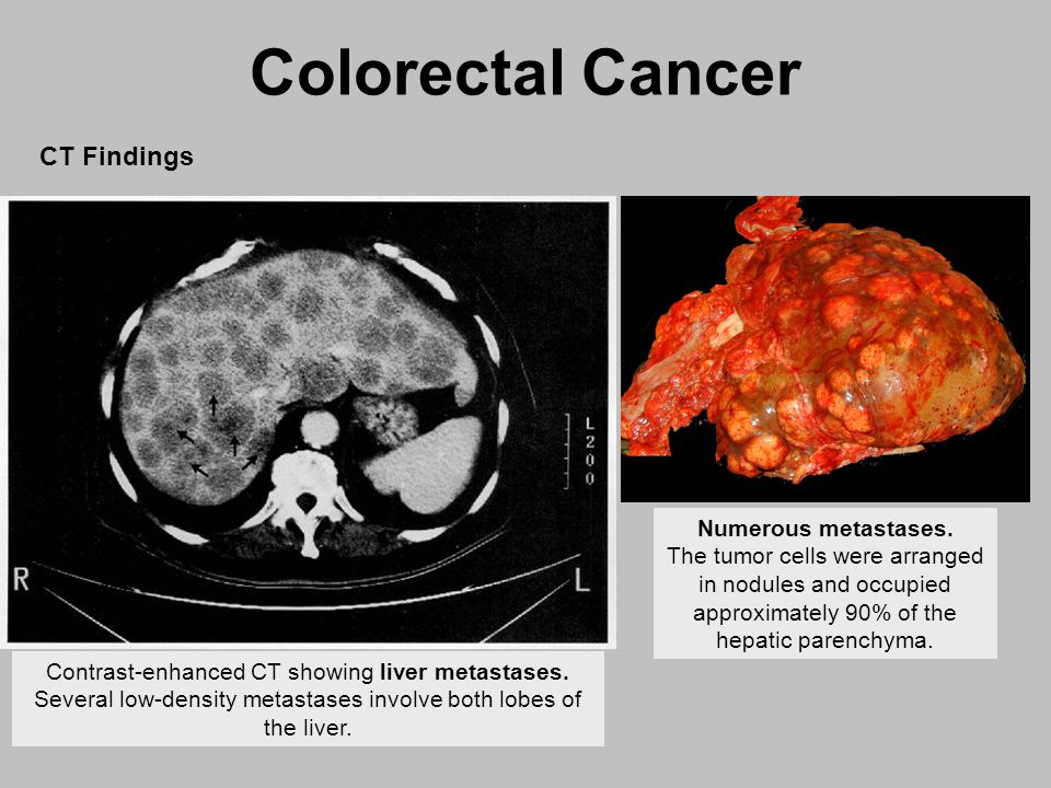 Colorectal Cancer Ppt Video Online Download