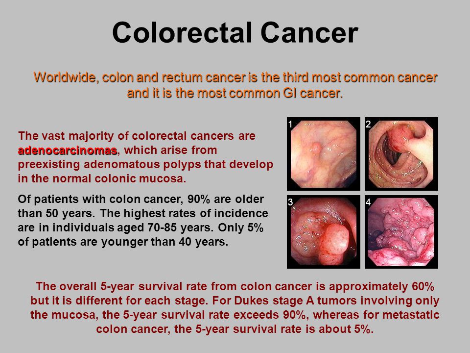 colorectal cancer 5 cm
