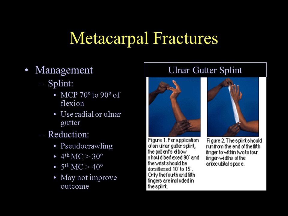 Management Of Extremity Fractures Ppt Video Online Download