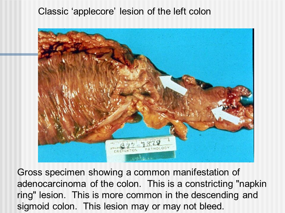 Pathology of Adenocarcinoma-Colon - Pathology Made Simple