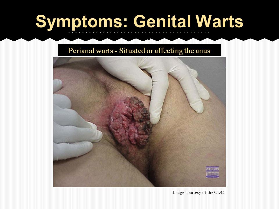 Symptoms: Genital Warts HPV.
