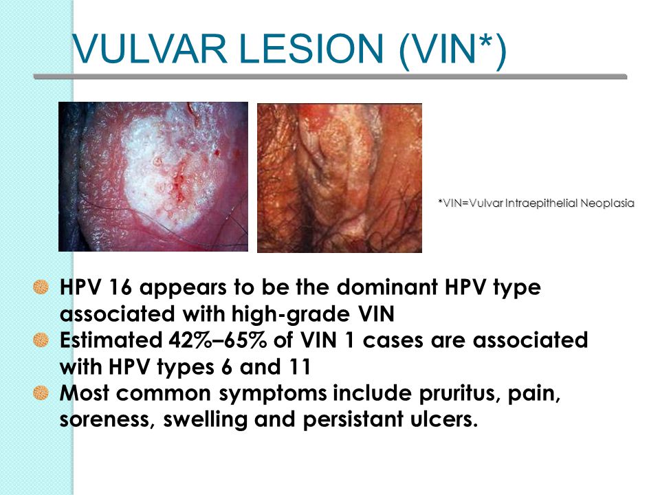 Vulvar cancer causes, risk factors, and prevention risk factors for vulvar cancer