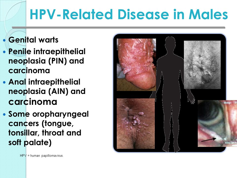 Cancer caused by hpv in males