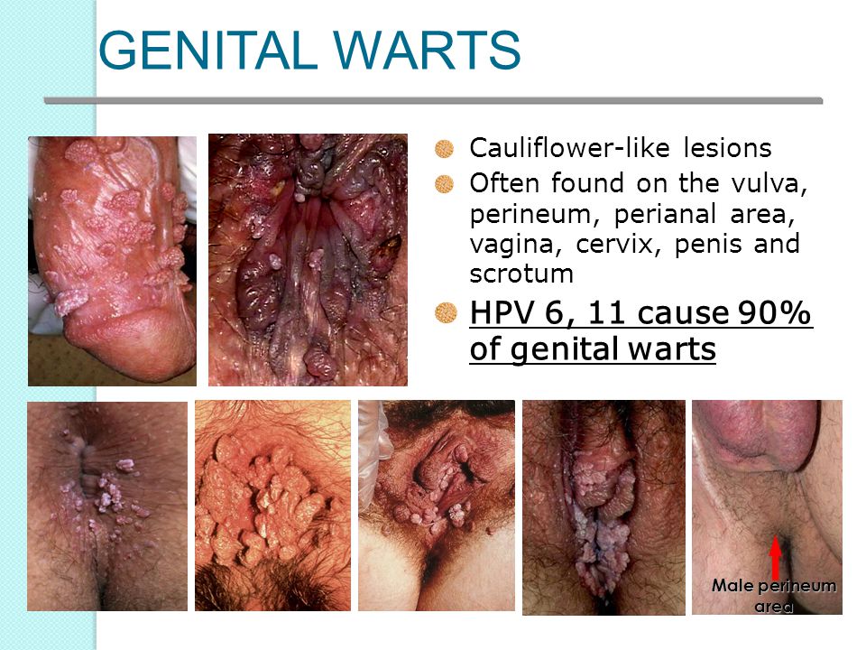 GENITAL WARTS HPV 6, 11 cause 90% of genital warts.