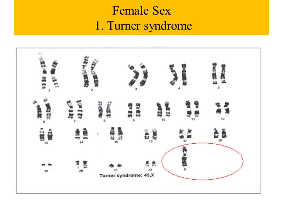 Female Sex 1. Turner syndrome.