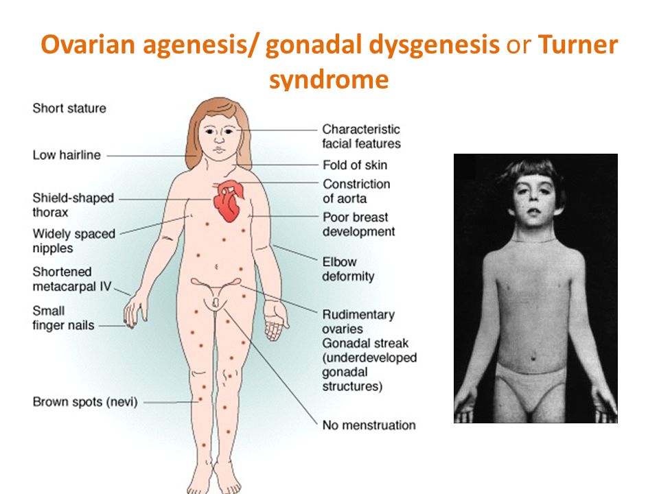 Ovarian agenesis/ gonadal dysgenesis or Turner syndrome.