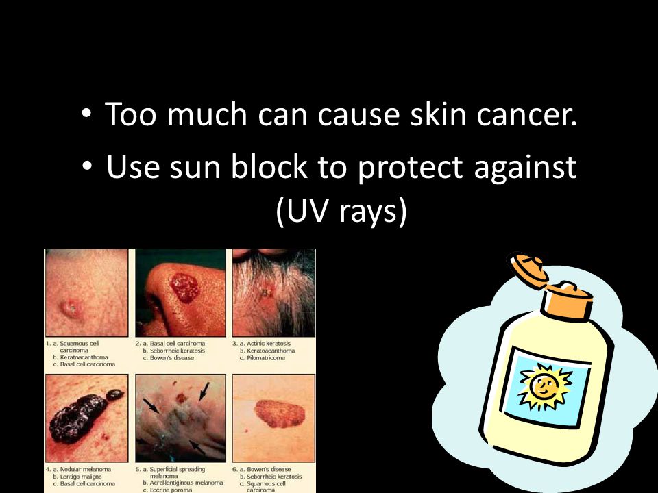 Too much can cause skin cancer.