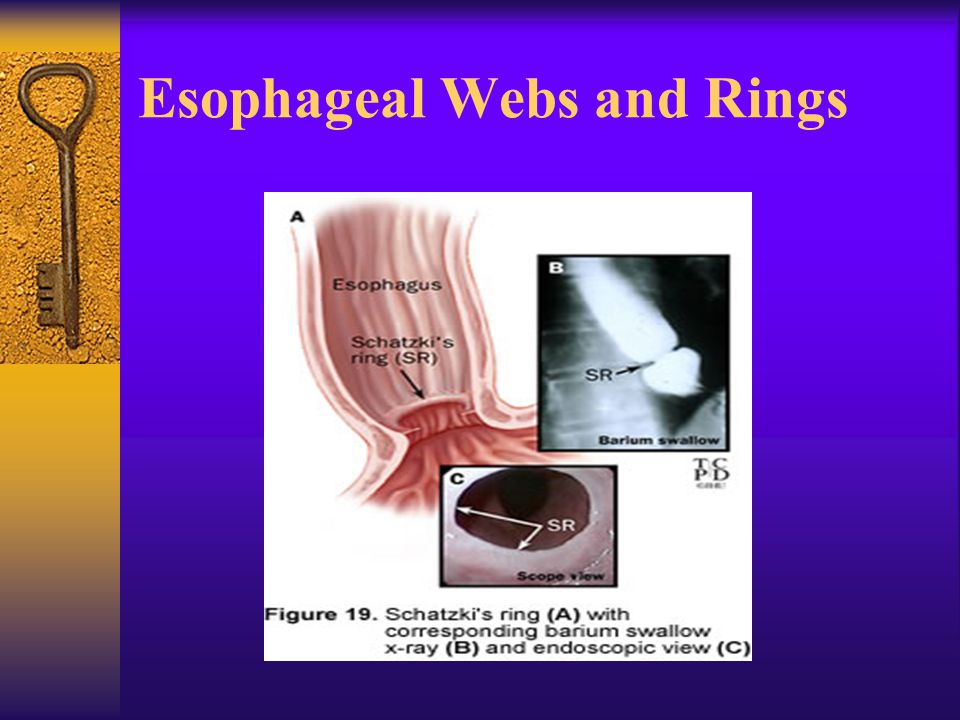 PDF) A Rare Coincidence of Esophageal Intramural Pseudodiverticulosis with Esophageal  Web