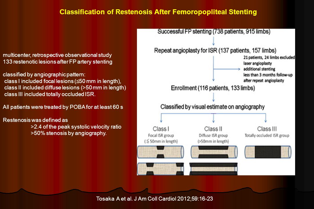 Classification of Restenosis After Femoropopliteal Stenting