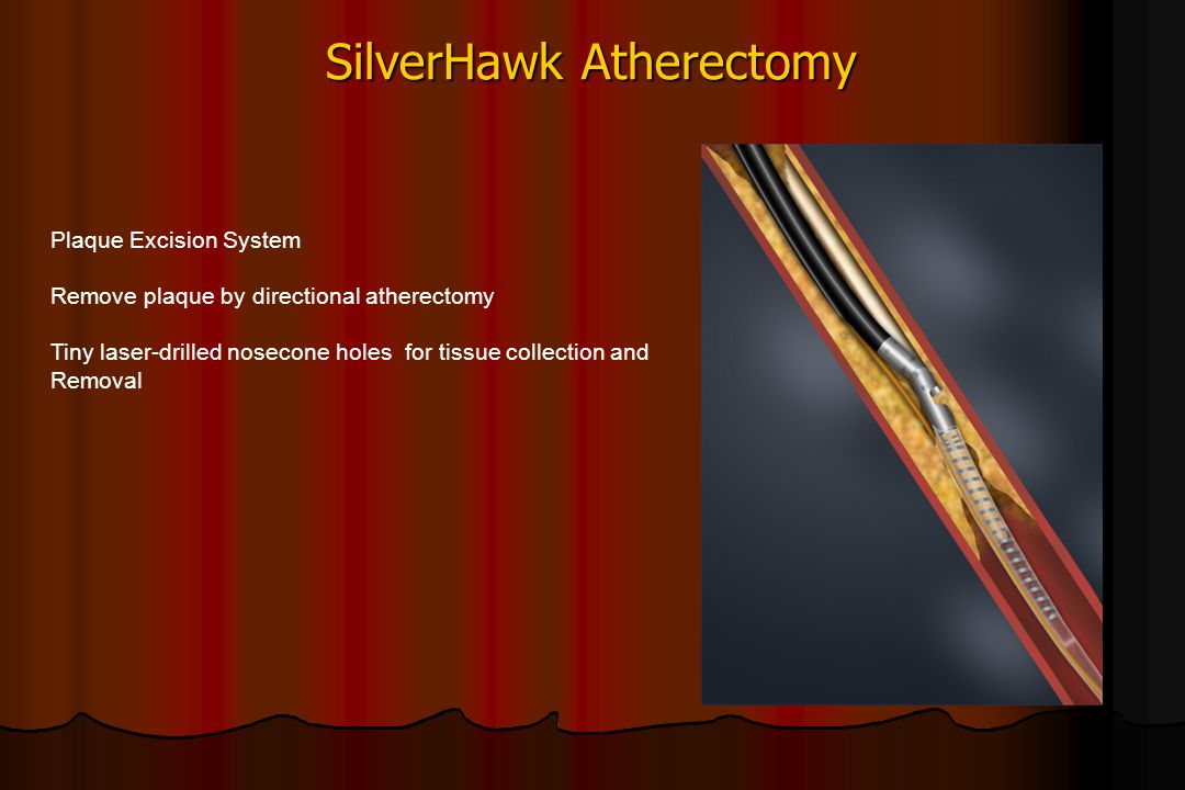 SilverHawk Atherectomy