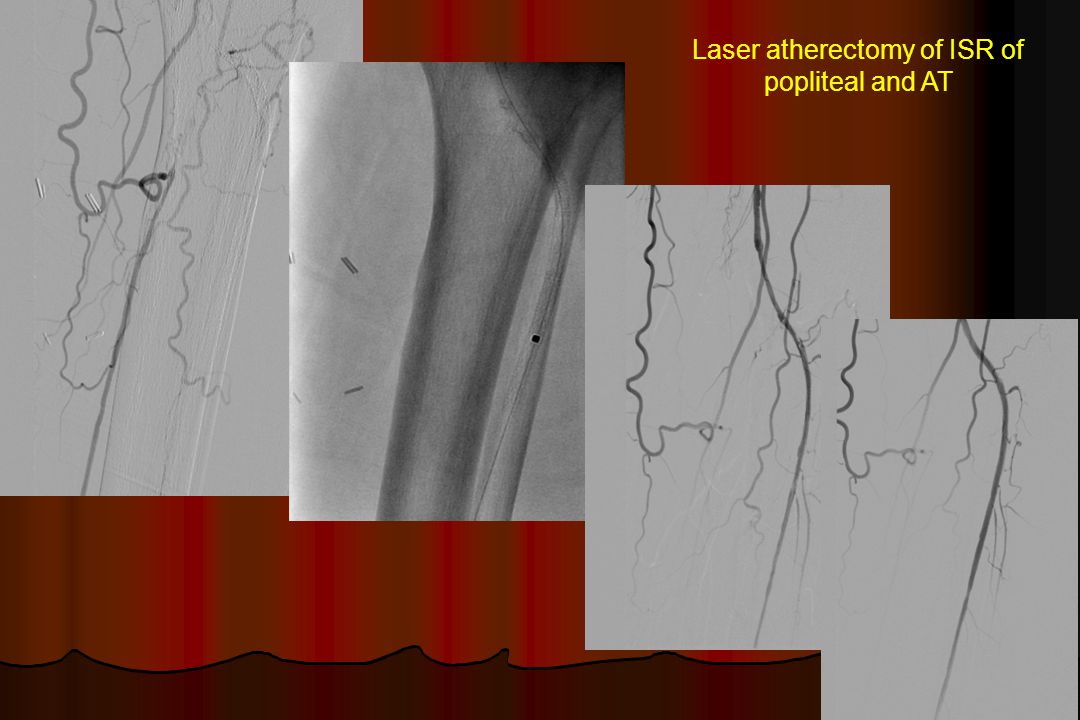 Laser atherectomy of ISR of popliteal and AT